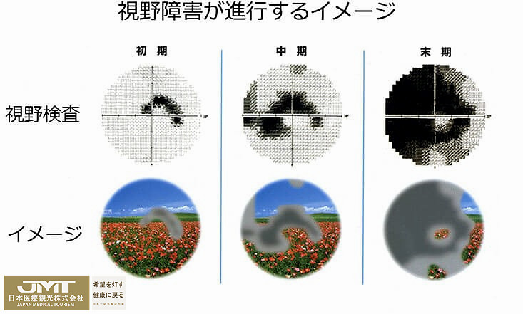 青光眼|JMT日本慢性病治疗-抑制青光眼的发展可有效避免失明