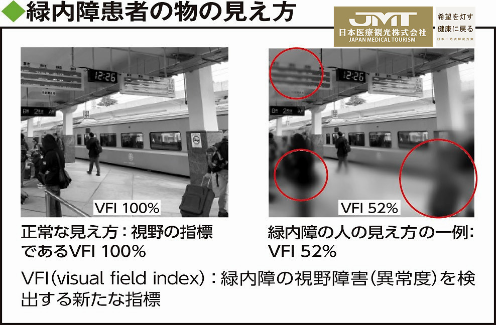 青光眼|JMT日本慢性病治疗-抑制青光眼的发展可有效避免失明