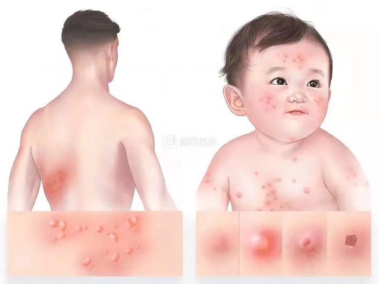 传染病|春季常见传染病预防小知识，你学会了吗？