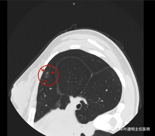 經驗積累202139年輕的肺混合磨玻璃結節請複查一下