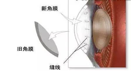 人工角膜|国产人工角膜要来了！那一天，他们终将“看”到