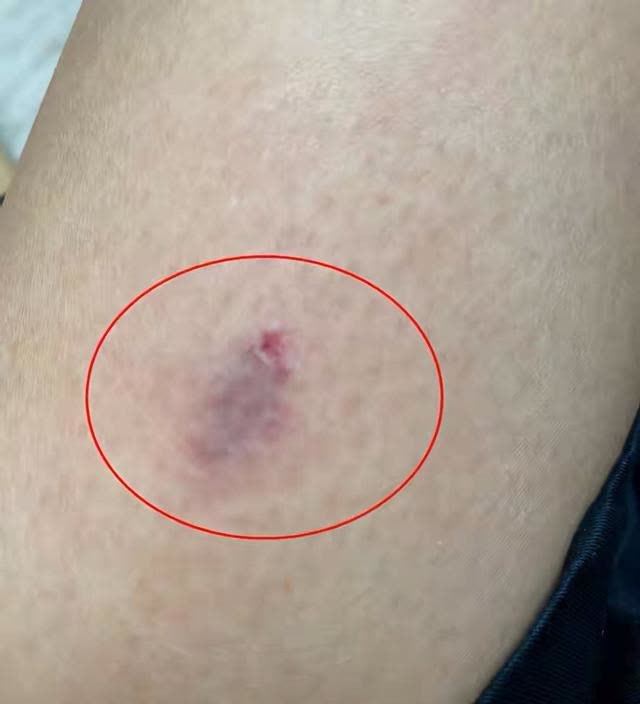 蔡少芬录制节目被狗咬了伤口严重不堪入目深夜紧急前往医院