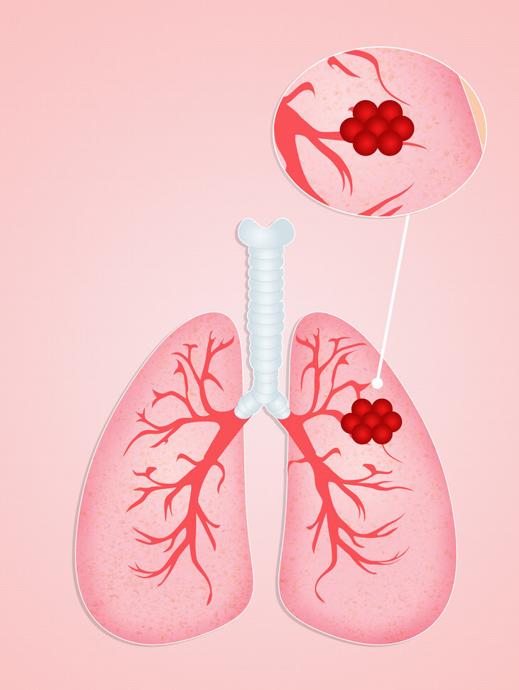 结节|肺结节为何要做靶扫描？可更加具体地提供结节的细节，诊断更准确