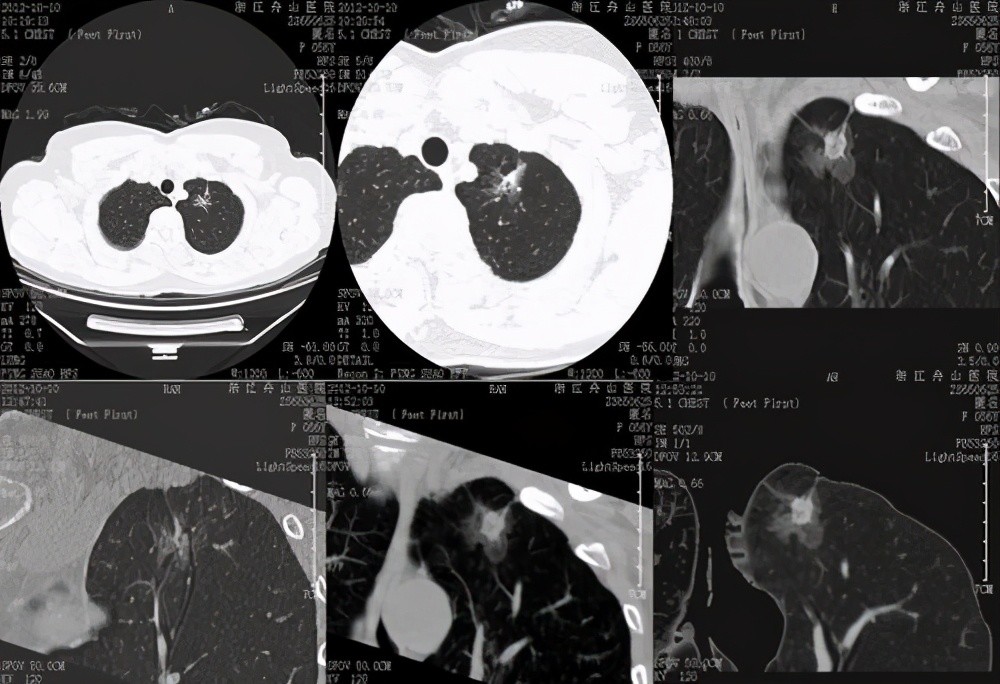 结节|肺结节为何要做靶扫描？可更加具体地提供结节的细节，诊断更准确