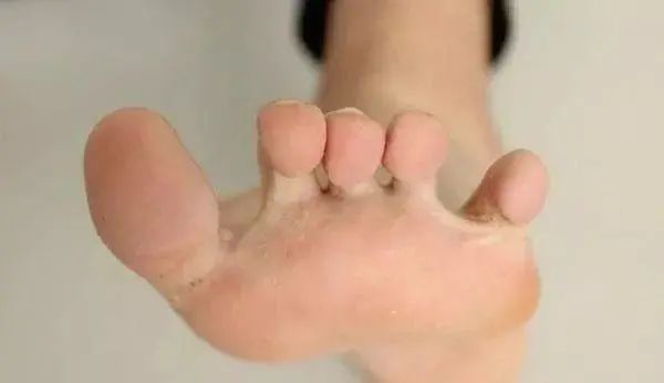 空腹血糖|血糖多少算是正常的？脚部出现4个异常表现，血糖已经超标