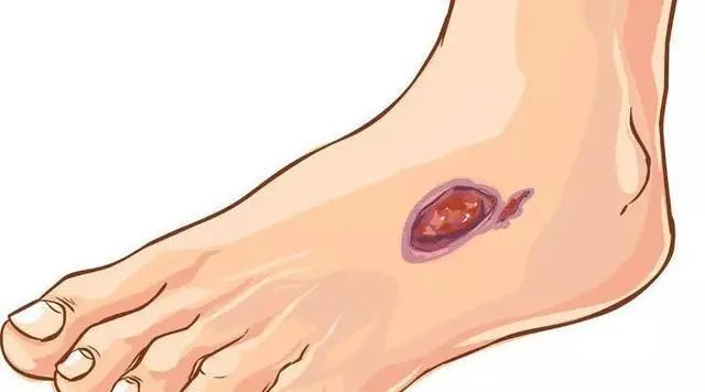 空腹血糖|血糖多少算是正常的？脚部出现4个异常表现，血糖已经超标