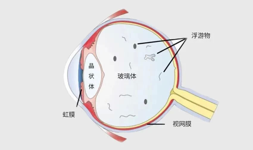 飞蚊症|眼睛里面长了虫子还会扭？眼科专家：当心“飞蚊症”！