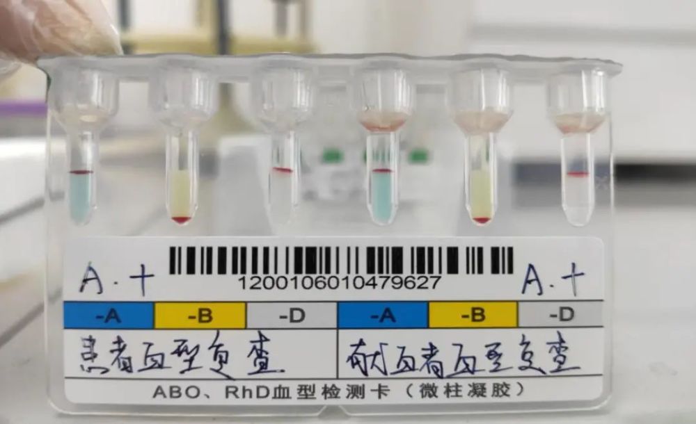 图2 交叉配血首查结果及复查结果回科室后询问了值班老师具体操作过程