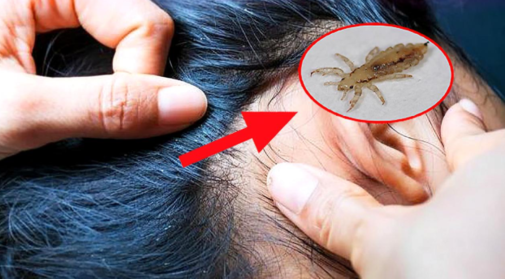 农村几十年前很多人头上都有虱子,怎么突然没了?虱子寿命多长?