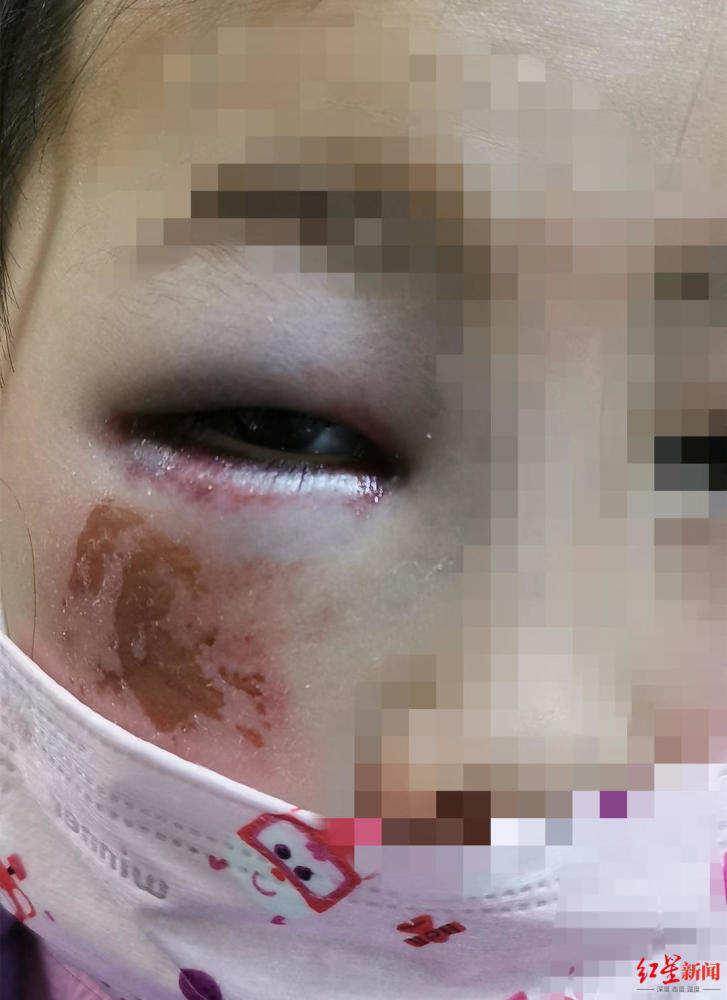 8岁小学生算错题遭老师殴打险致失明官方看视频判断