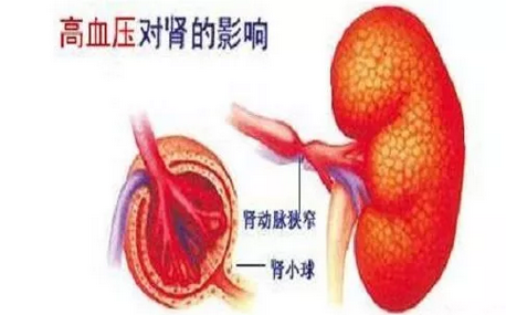 高血压,糖尿病与肾病为何爱搞"三结合?