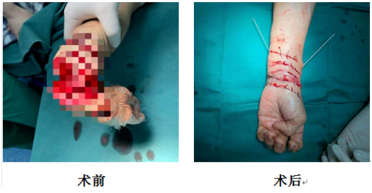 疼!湖北荆门一女子自杀,用刀砍自己的手,手从手腕断开仅剩一点皮连