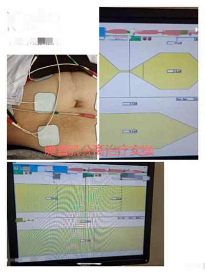 圍觀女性必修盆底課之腹直肌分離快來了解一下吧