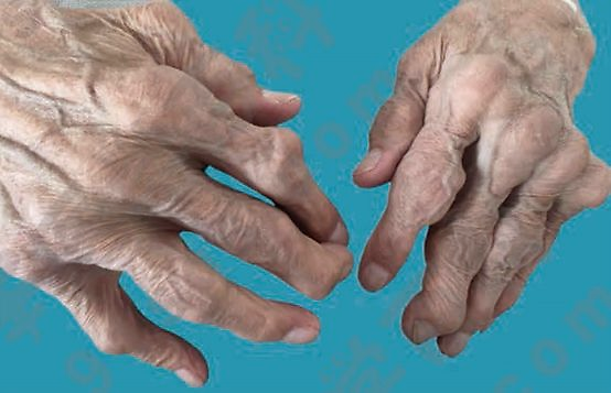 每4个类风湿关节炎患者就有1人出现这种问题