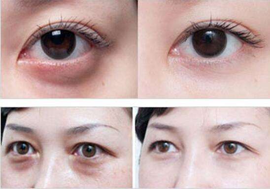 眼袋,不止增加了你的年龄,还和健康有关_腾讯新闻