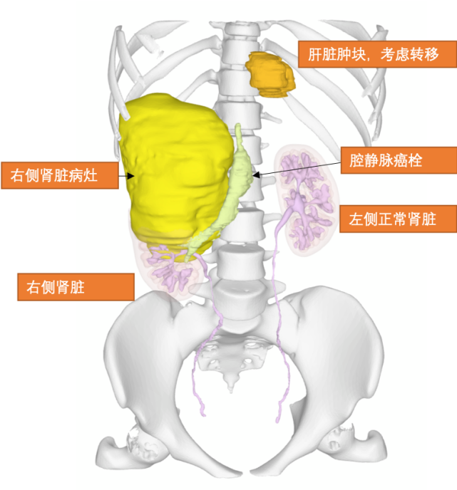 苏州女大学生癌症晚期 苏大附一院医生提醒 这些别碰 黄玉华 肿瘤 肾癌 苏州 医生