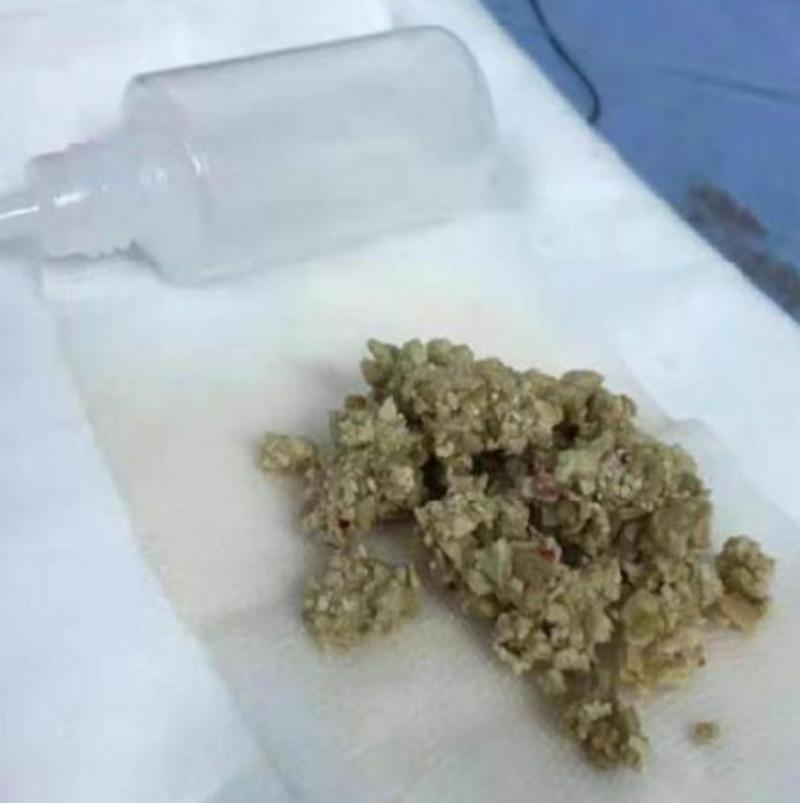 腰痛久治不愈竟是肾脏长满水泥状结石出现这些症状要当心