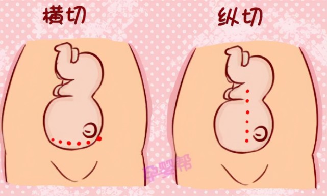 名医专访丨深圳大学总医院陈香娟剖宫产腹部切口心形美容缝合