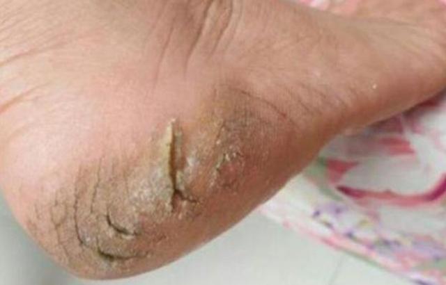 若脚上出现3种"异常",建议查肝ct,多喝一茶_腾讯新闻