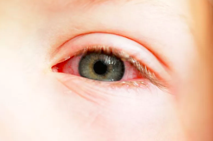 畏光|护眼|过敏性结膜炎|干眼症|红肿|红眼病