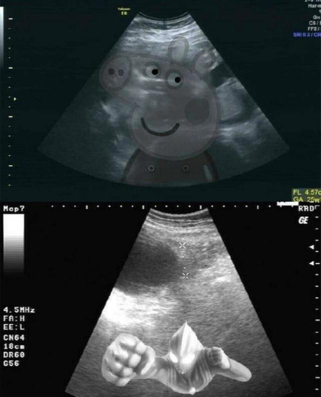 因为本来这是一个b超的照片,却被网友p了小猪佩奇和奥特曼,笑出猪叫声