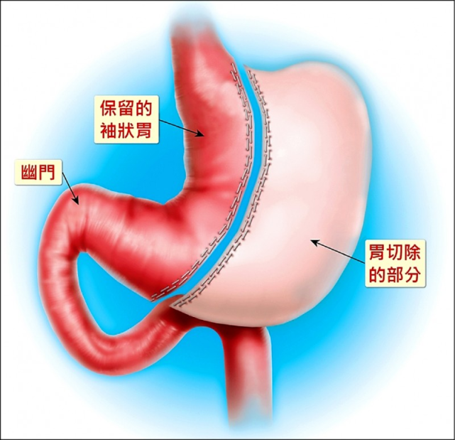 医生:可以,但减重手术非人人适合