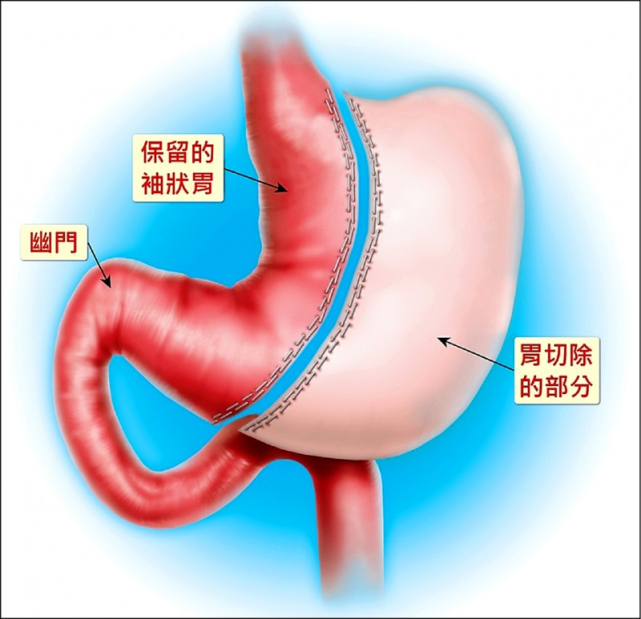 切胃真能瘦下去?医生:可以,但减重手术非人人适合