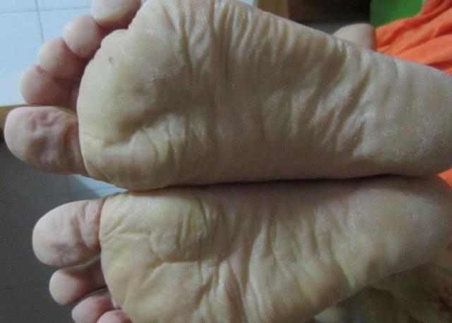 肝不好,脚先知?若脚上出现3种"异常",建议查肝ct,多喝一茶
