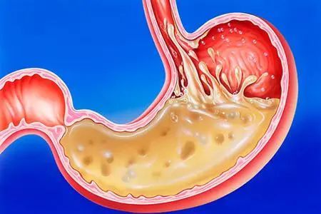 萎缩性胃炎|慢性萎缩性胃炎，主要是由两大病因造成的，搞清病因再吃药！