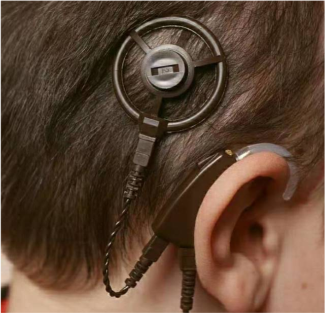 神经性耳聋|助听器|感音神经性耳聋|人工耳蜗植入