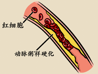 阿司匹林|预防心脑血管疾病的“百年好药”，阿司匹林该怎么吃？