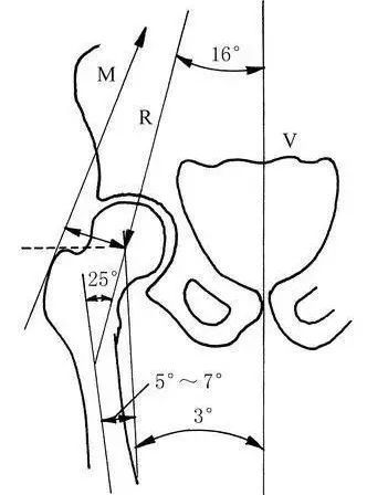 髖關節不同於其他負重關節那樣兩骨端關節力線垂直,股骨幹與股骨頭頸