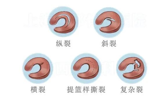薇娅做手术上热搜这种病年轻人高发