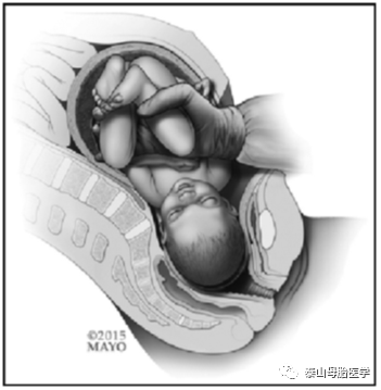 佳文分享|嵌顿胎头,第二产程剖宫产(sogc专家共识第415号)