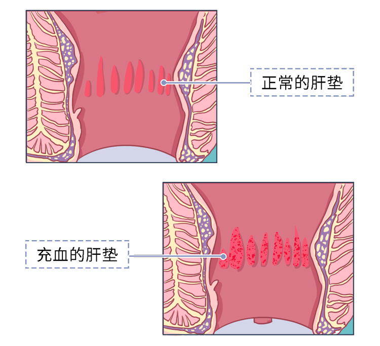 肛瘻患者不想治了我真的太痛了肛瘻手術到底有多痛