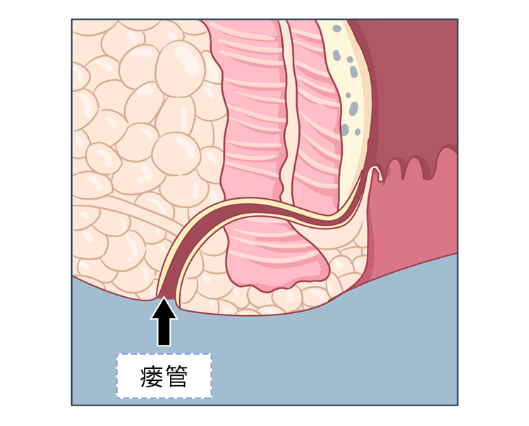 "肛瘘手术,到底有多痛?
