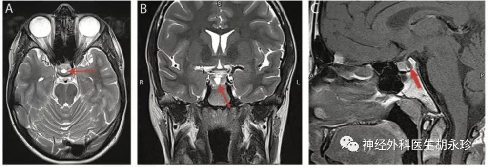鞍区囊性病变的诊断