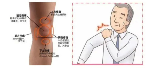 关节和软组织疼痛:肩关节疼痛,膝关节疼痛,骶髂关节疼痛,广泛肌筋膜炎