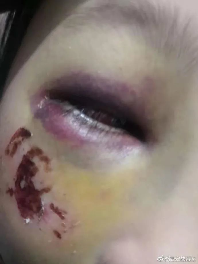 8岁女生被老师暴打涉事教师停职