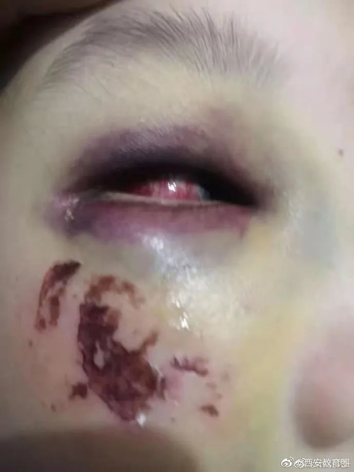 8岁女生被老师暴打涉事教师停职