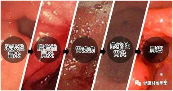 【营养治疗】慢性浅表性胃炎是什么病?看完你就知道了!