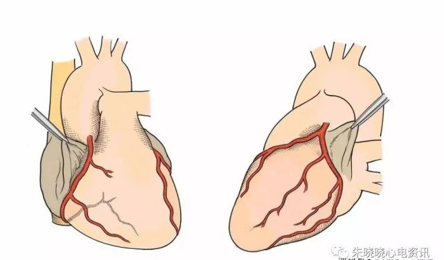 心梗犯罪血管,1張流程圖全搞定!