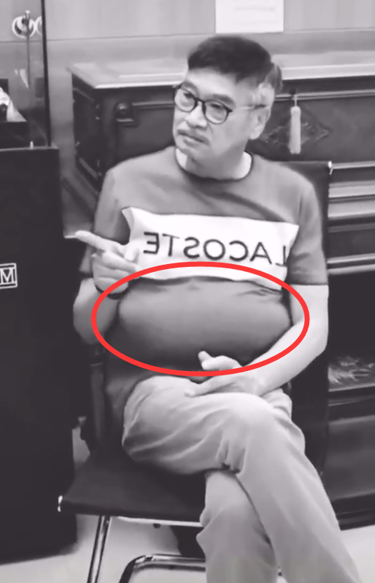 粉丝公开吴孟达肝癌晚期照片肝腹积水非常严重肚子大的像吹起来的气球