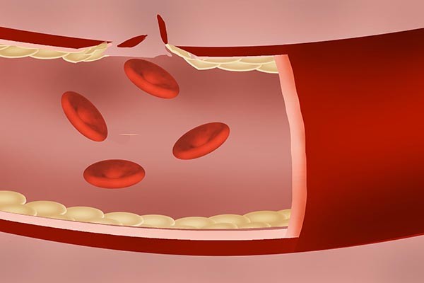 高血脂|高血脂除了要限制肉食，还要补充什么养分？