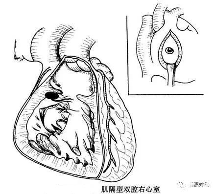 心室|双腔右心室形成和分型