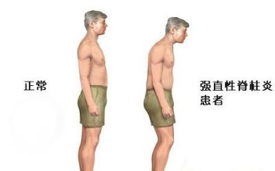 强直性脊柱炎|春天是万物复苏的季节，强直性脊柱炎患者如何避免复发呢？