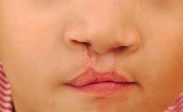 怀孕6个月查出胎儿有兔唇,不想宝宝有兔唇,避免这5件事情