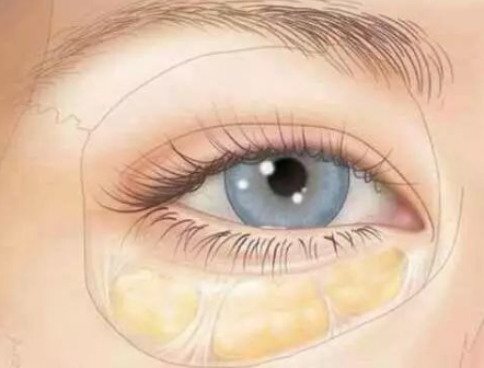 get正确祛眼袋方式,让眼部肌肤重回年轻态