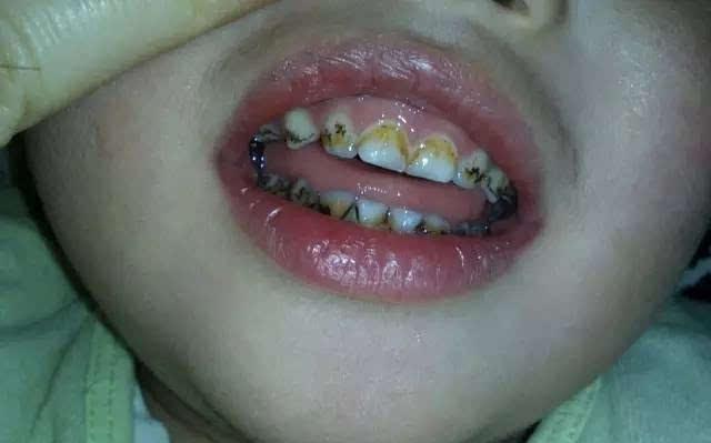 三岁女孩满口小黑牙,宝妈完全不在意,医生:再不来就晚了