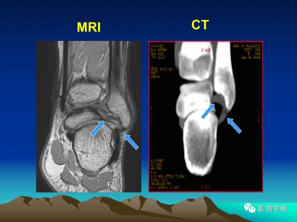 踝關節外側韌帶急性損傷的mri表現